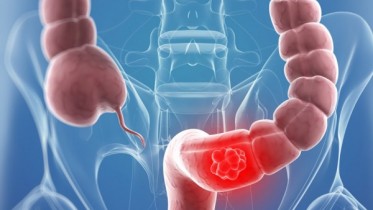 Colon Cancer
