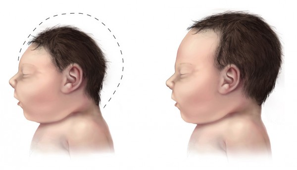 Government document confirms vaccine link to microcephaly
