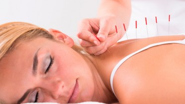 womangettingacupuncture